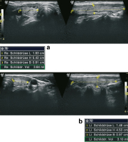 Abbildung 2a-b: Subakute Thyreoiditis