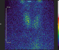 Abbildung 5: Subakute Thyreoiditis