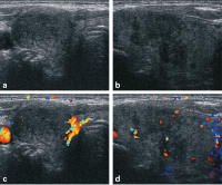 Abbildung 6a-d: Subakute Thyreoiditis