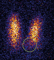 Abbildung 1: Schilddrüsenkarzinom