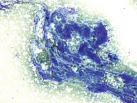 Abbildung 2: Schilddrüsenkarzinom