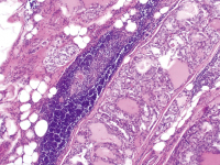 Abbildung 4: Schilddrüsenkarzinom