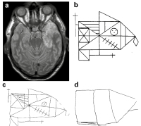 Abbildung 2a-d: Amnestisches Syndrom