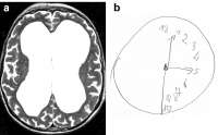 Abbildung 3a-b: Dysexekutives Syndrom