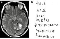 Abbildung 4a-b: Lesestörung-Alexie