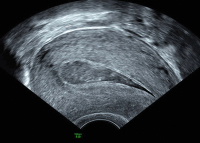 Abbildung 2: Ultraschall-Serometra