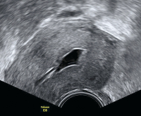 Abbildung 4: Ultraschall-Serometra