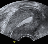 Abbildung 7: Ultraschall-Serometra