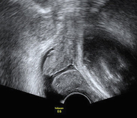Abbildung 10: Ultraschall-Serometra