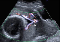 Abbildung 5: Insertio velamentosa