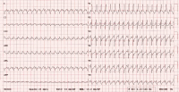 Abbildung 3: EKG - Adenosin 
