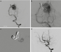 Abbildung 2a-d: Embolisationstechniken