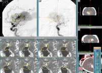 Abbildung 3: Gamma-Knife-Behandlung