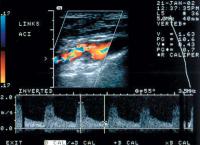 Abbildung 7b: Duplexsonographie - Karotis