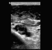 Abbildung 3: Thrombus - Vena subclavia