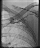 Abbildung 4: Präinterventionelle Angiographie