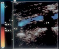 Abbildung 19: Duplexsonographie - A./V. vertebralis
