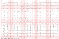 Abbildung 1: EKG bei Aufnahme