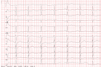 Abbildung 2: EKG nach Kardioversion