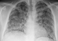 Abbildung 3: Thoraxröntgen