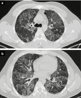 Abbildung 4a-b: Thorax-CT
