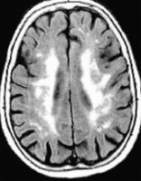 Abbildung 2: White Matter Läsionen