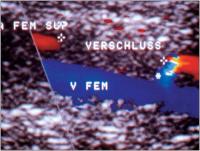 Abbildung 13: Duplexsonographie - A. femoralis - Stenose