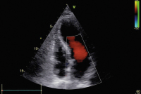 Abbildung 2: Thrombus