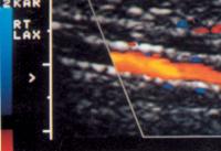 Abbildung 16: Duplexsonographie - A. tibialis post. - Sklerose