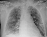 Abbildung 2: Thoraxröntgen