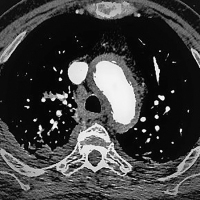 Abbildung 3: Thorax-CT