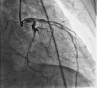 Abbildung 4: Koronarangiographie