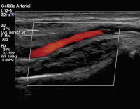 Abbildung 3: Duplexsonographie