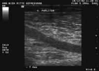 Abbildung 5: Duplexsonographie - V. poplitea