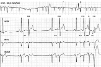 Abbildung 4: Atriale Extrasystole
