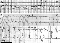 Abbildung 9: Ashman-Phänomen - VES