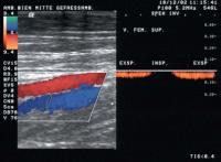 Abbildung 6: Duplexsonographie - Spontanes Venensignal