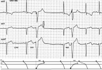 Abbildung 23: VES - AVN
