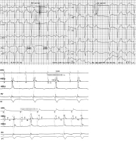 Abbildung 33: Infrahissärer Wenckebach-Typ AV-Block II