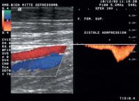 Abbildung 7: Duplexsonographie - Kompression