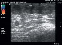 Abbildung 13: Duplexsonographie - Thrombophlebitis