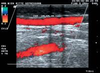 Abbildung 15: Duplexsonographie - insuffiziente V. saphena parva