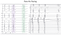 Abbildung 4: Para-His-Pacing