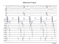 Abbildung 6: Adenosin-Test