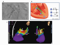 Abbildung 7: EPU-Katheter