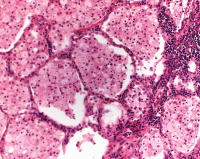 Abbildung 4: Lipidpneumonie - EVALI