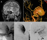 Abbildung 1A-E: Intrakranielles Aneurysma