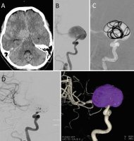 Abbildung 5A-E: Intrakranielles Aneurysma
