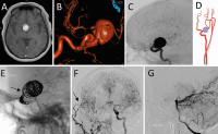Abbildung 9A-G: Intrakranielles Aneurysma