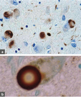 Abbildung 1a-b: Lewy-Pathologie